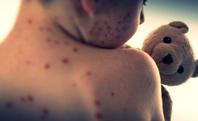 Measles death toll climbs to 10 in Mongolia