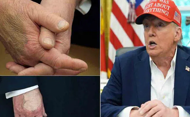 Mysterious Marks on Trump’s Right Hand